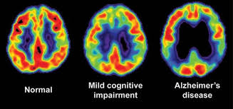 Brain scans showing progression from normal cognition to mild cognitive impairment to Alzheimer's disease